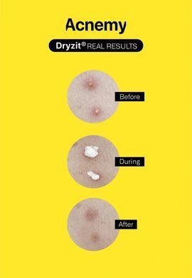 Підсушуючий точковий лосьон від прищів Acnemy DRYZIT