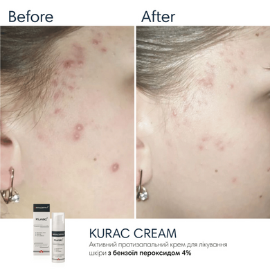 Активний протизапальний крем з бензоїл пероксидом 4% Braderm Kurac Cream