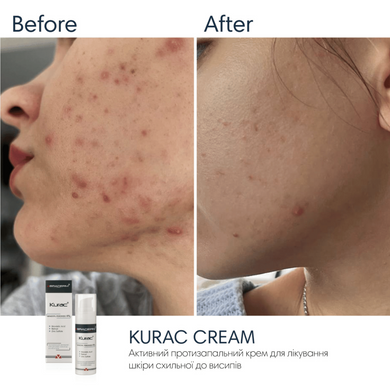 Активний протизапальний крем з бензоїл пероксидом 4% Braderm Kurac Cream