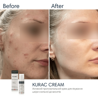 Активний протизапальний крем з бензоїл пероксидом 4% Braderm Kurac Cream