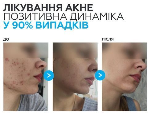 Активний протизапальний крем з бензоїл пероксидом 4% Braderm Kurac Cream