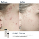 Активний протизапальний крем з бензоїл пероксидом 4% Braderm Kurac Cream