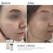 Активний протизапальний крем з бензоїл пероксидом 4% Braderm Kurac Cream