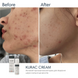 Активний протизапальний крем з бензоїл пероксидом 4% Braderm Kurac Cream